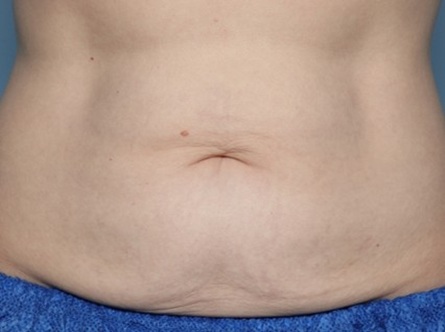 Before Image: Thermage – Abdomen - front
